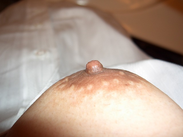 女性化乳房が乳首と乳輪2