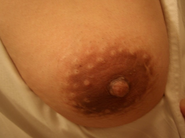 女性化乳房が乳首と乳輪3