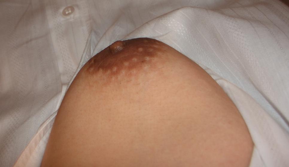 女性化乳房のおっぱい2