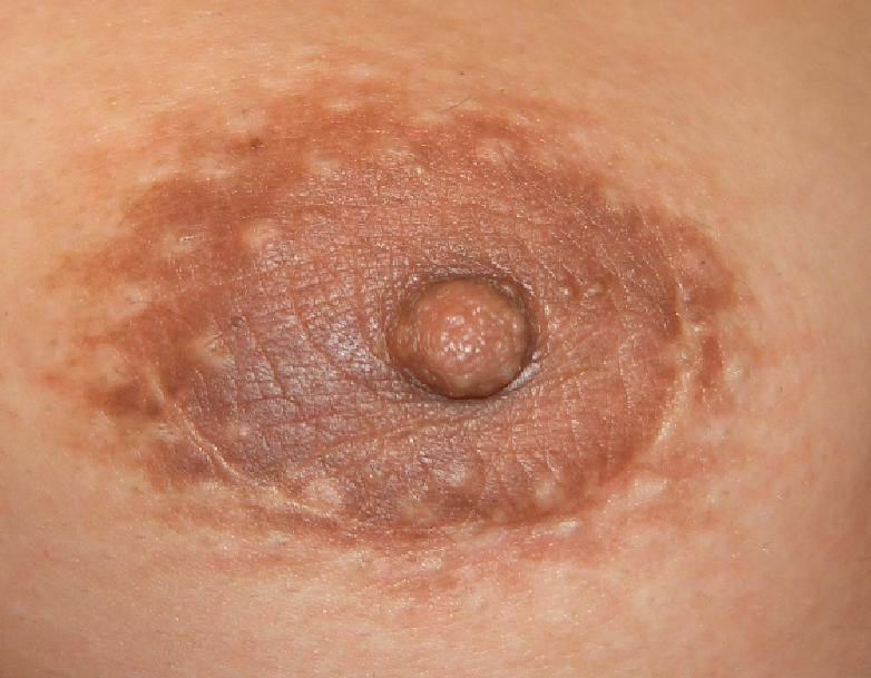 女性化乳房の手術跡